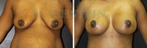 Breast Lift With Implants Patient