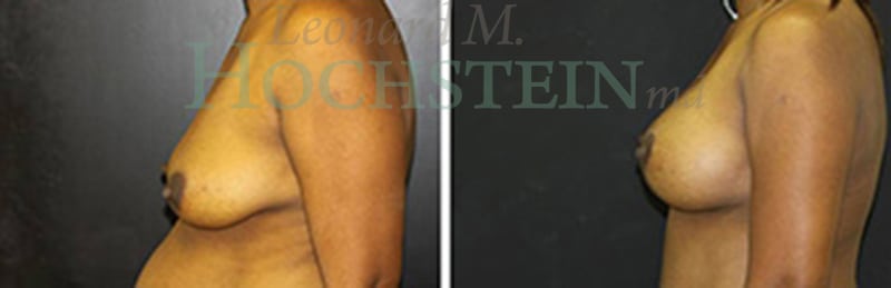 Breast Lift With Implants Patient