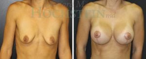 Breast Lift With Implants Patient