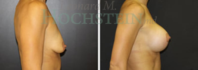 Breast Lift With Implants Patient