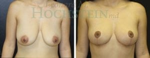 Breast Lift With Implants Patient