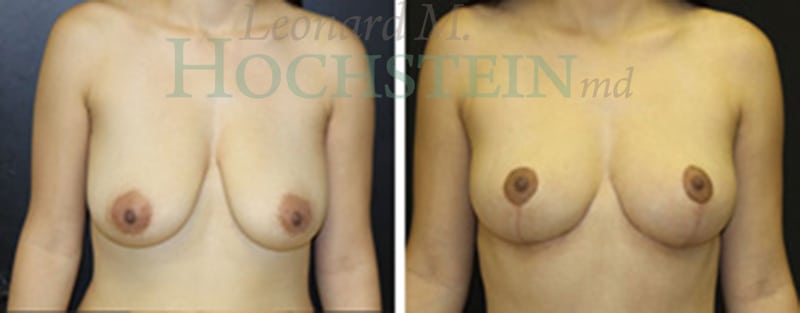 Breast Lift With Implants Patient