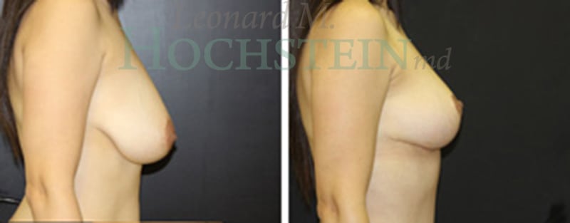 Breast Lift With Implants Patient