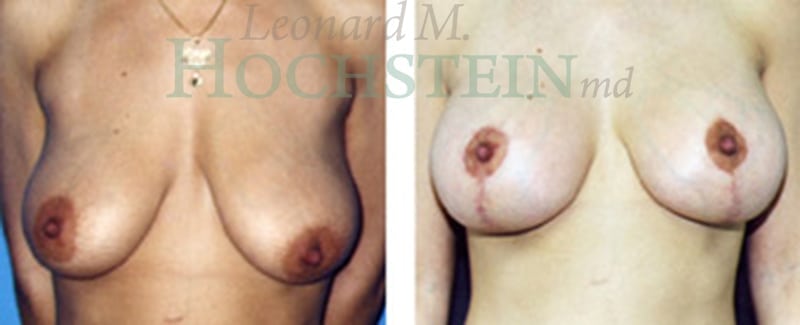 Breast Lift With Implants Patient