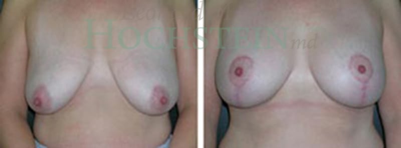 Breast Lift With Implants Patient