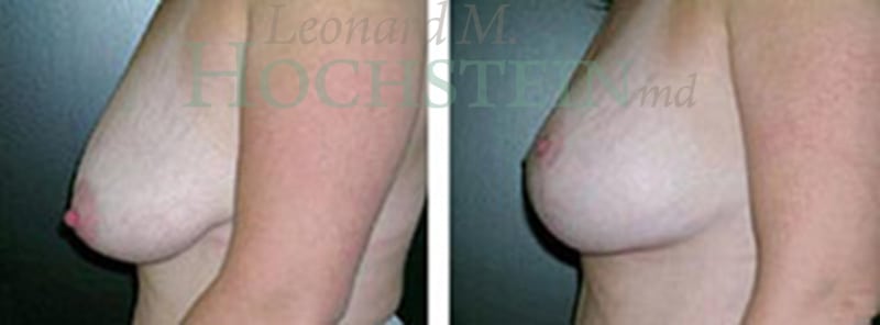Breast Lift With Implants Patient