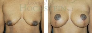 Breast Lift With Implants Patient