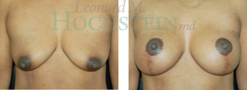 Breast Lift With Implants Patient