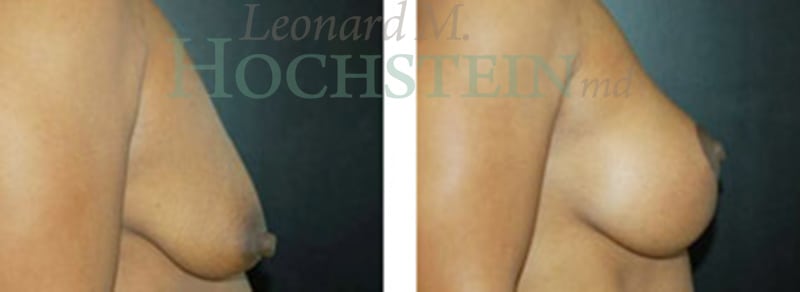 Breast Lift With Implants Patient