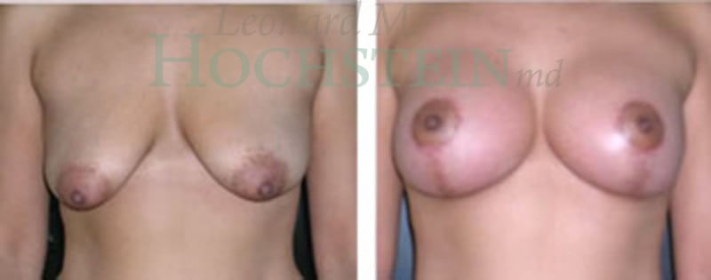 Breast Lift With Implants Patient