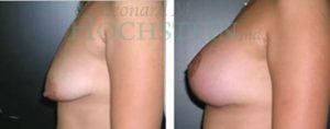 Breast Lift With Implants Patient