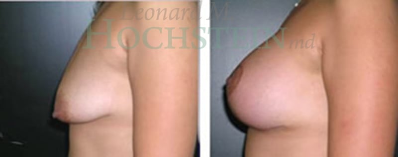 Breast Lift With Implants Patient