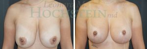 Breast Lift With Implants Patient