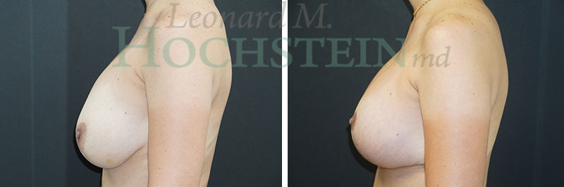 Breast Lift With Implants Patient