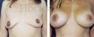 Breast Lift With Implants Patient