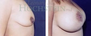 Breast Lift With Implants Patient