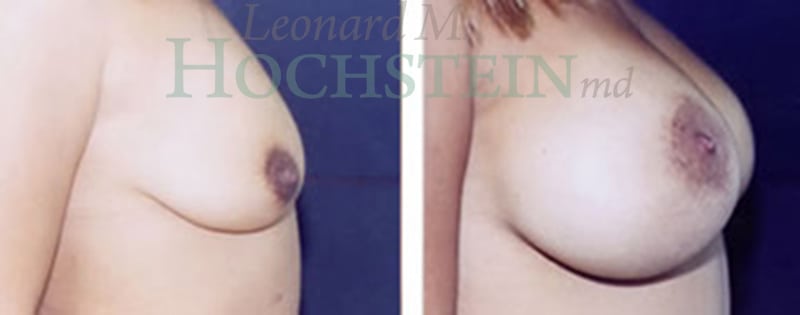 Breast Lift With Implants Patient