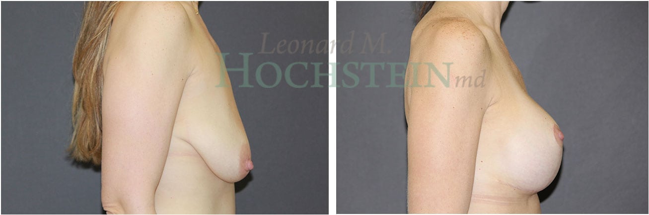 Breast Lift With Implants Patient