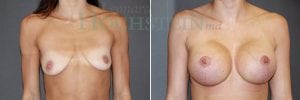 Breast Lift With Implants Patient