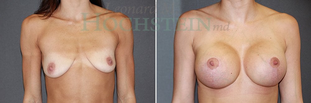 Breast Lift With Implants Patient