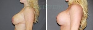 Breast Lift With Implants Patient