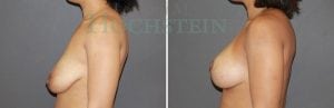 Breast Lift With Implants Patient