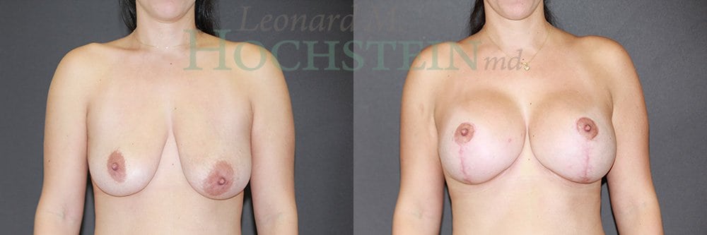 Breast Lift With Implants Patient