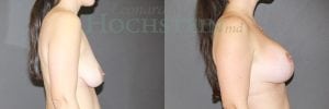 Breast Lift With Implants Patient
