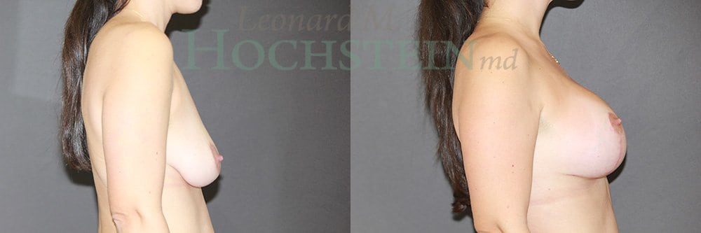 Breast Lift With Implants Patient