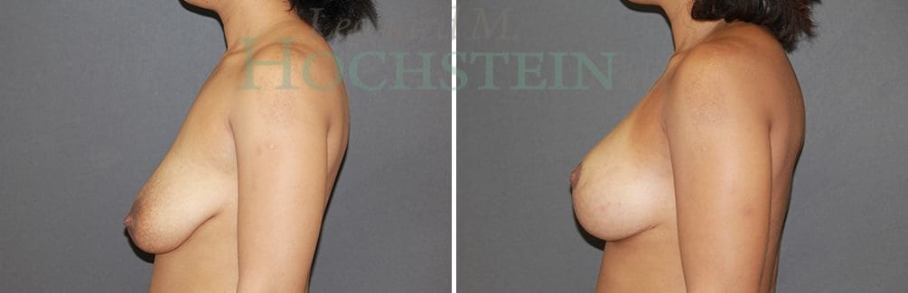 Breast Lift With Implants Patient