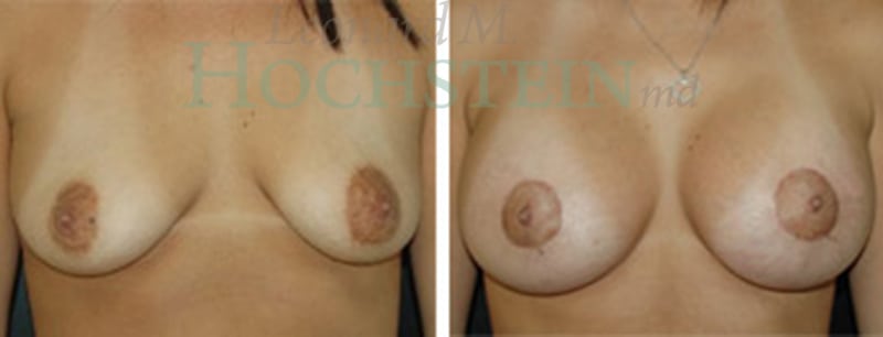 Breast Lift With Implants Patient