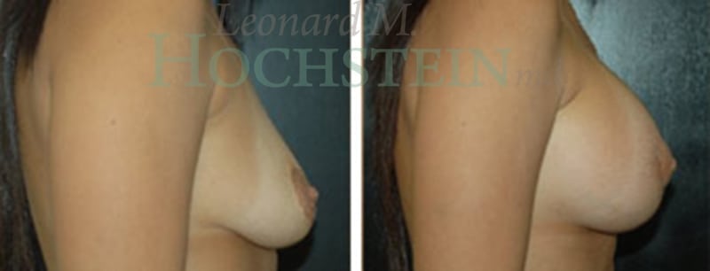 Breast Lift With Implants Patient