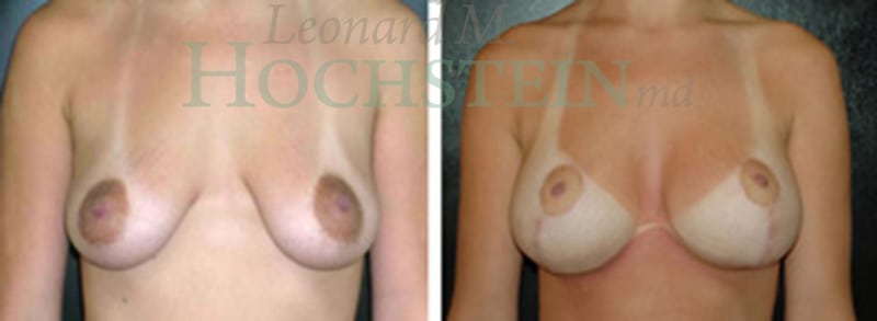 Breast Lift With Implants Patient