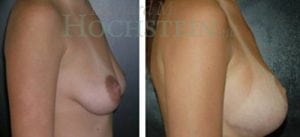 Breast Lift With Implants Patient