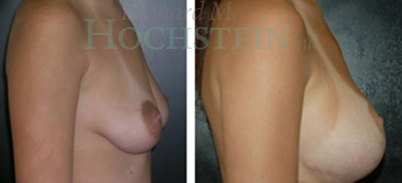 Breast Lift With Implants Patient