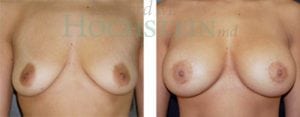 Breast Lift With Implants Patient