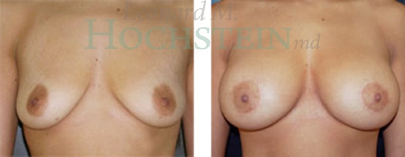 Breast Lift With Implants Patient