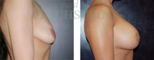 Breast Lift With Implants Patient