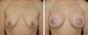 Breast Lift With Implants Patient