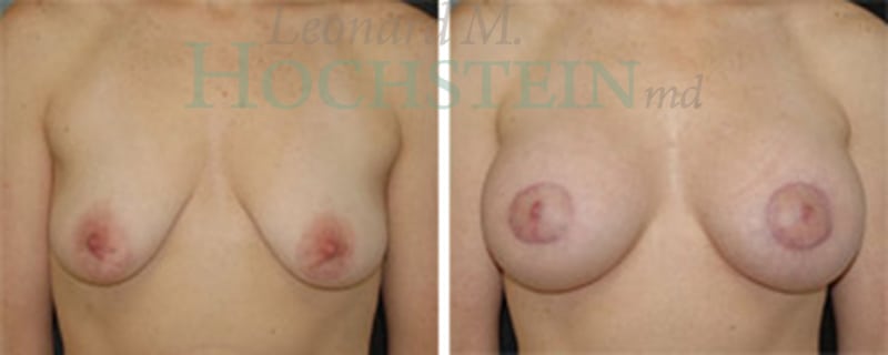 Breast Lift With Implants Patient