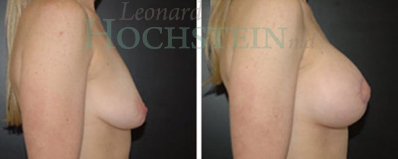 Breast Lift With Implants Patient