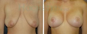 Breast Lift With Implants Patient