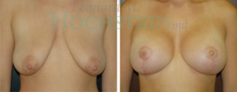 Breast Lift With Implants Patient