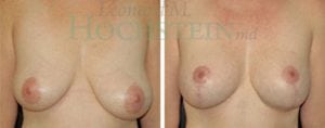 Breast Lift With Implants Patient