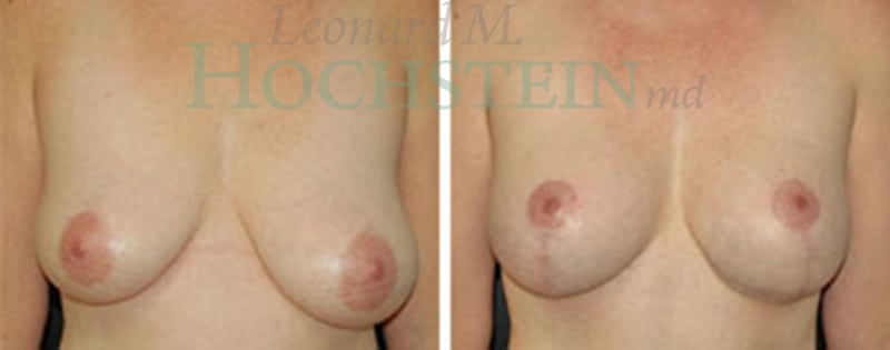 Breast Lift With Implants Patient