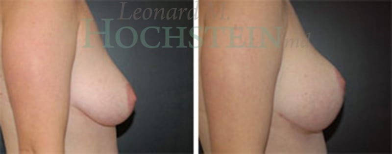 Breast Lift With Implants Patient