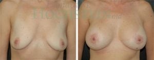 Breast Lift With Implants Patient