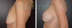Breast Lift With Implants Patient