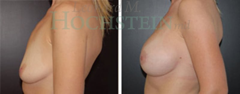 Breast Lift With Implants Patient
