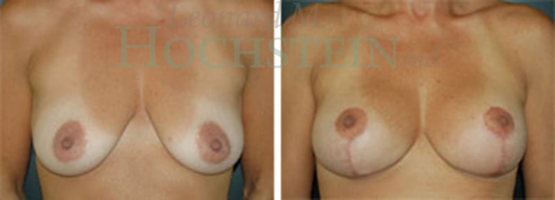 Breast Lift With Implants Patient